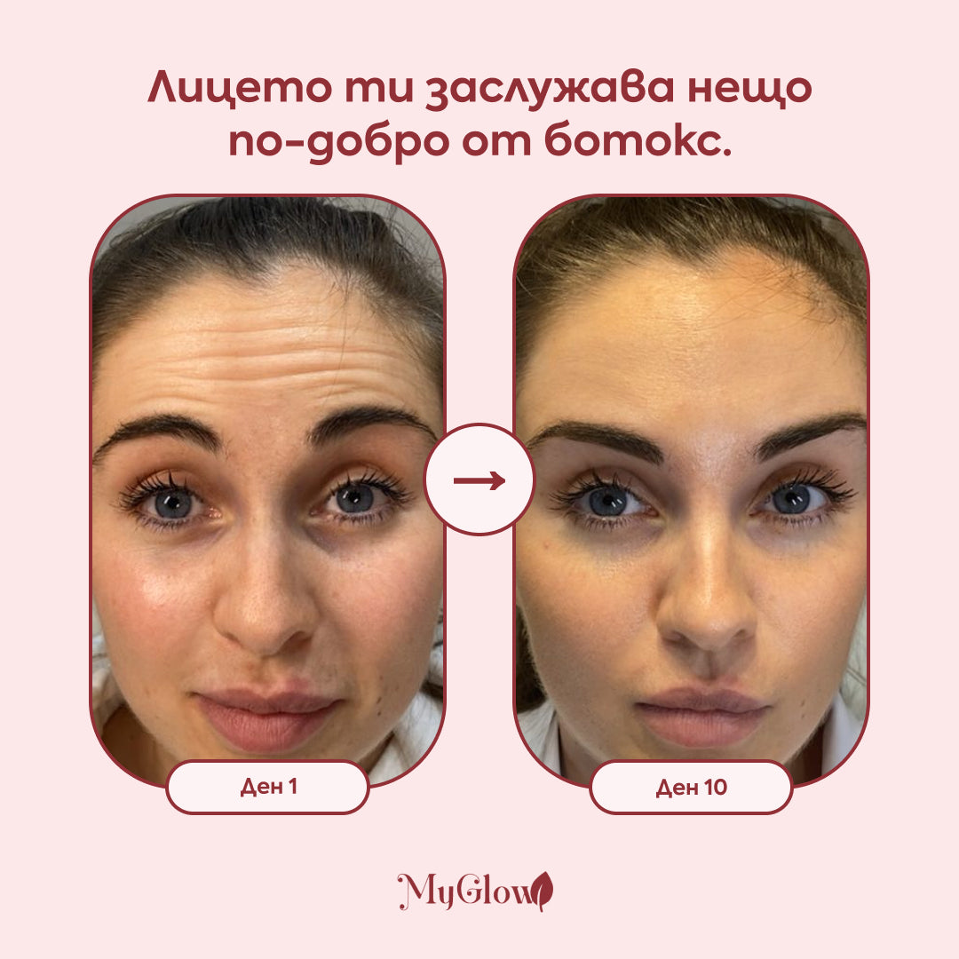 Superlift пластири за бръчки